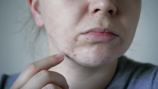 近距离皮肤问题 不健康的皮肤与痤疮和粉刺 毛茸茸的 迷幻的和迷幻的 红色的皮疹 护理问题肌肤的概念 过敏和红肿 — 图库视频影像