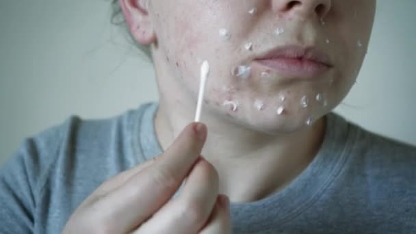 Close Skin Problems Unhealthy Skin Acne Pimples Porous Demodex Rosacea — Stock video