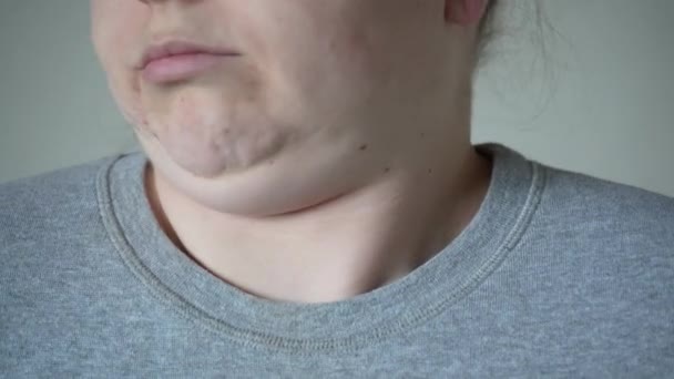 Retrato Flacidez Piel Colgante Grasa Arrugas Celulitis Debajo Barbilla Piel — Vídeo de stock