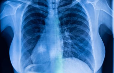 Akciğer kaburgaları x-ray tarama sonuçları.