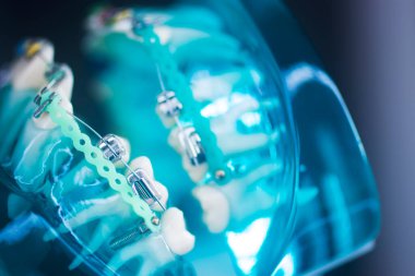 Diş macunu hizalayıcı diş etleri ve metal diş düzleştiricileri gösteren öğrenci modeli öğretiyor..