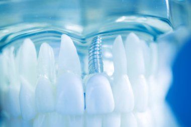 Diş implantı titanyum protez dişçi modeli..