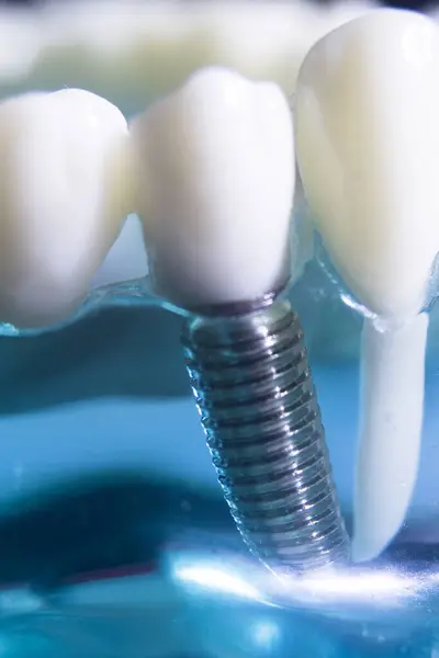 Dental tooth metal implant dentistry teaching model showing teeth and gum.