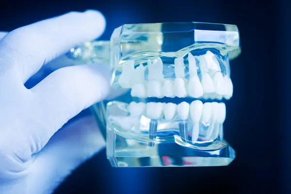 歯科用歯インプラントチタン人工歯科医モデル ストック写真