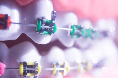 Modern metal parantez hizalayıcıları dişçiler tarafından dişlerin hizalanmasını düzeltmek için kullanılır.