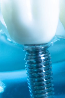 Diş macunu implantı. Diş ve sakız gösteren bir model..