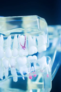 Diş çürüğü modeli dişlerdeki bakterileri gösteriyor.