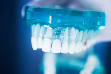 Diş implantı titanyum protez dişçi modeli..