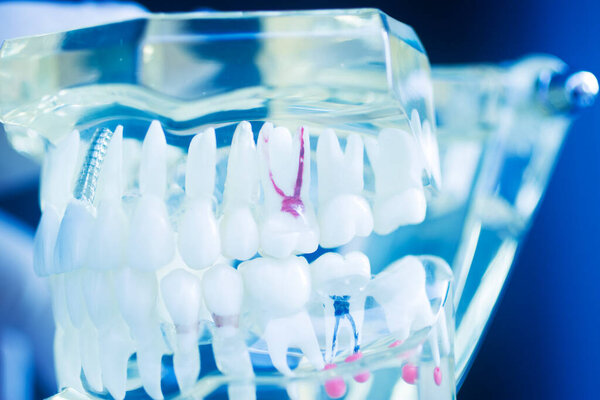 Teeth decay dentistry model showing caries in tooth