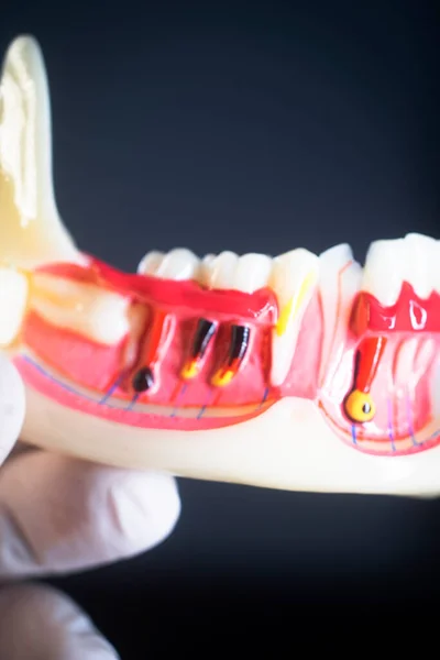 Tooth decay dentists dental model of teeth, gums and root canal