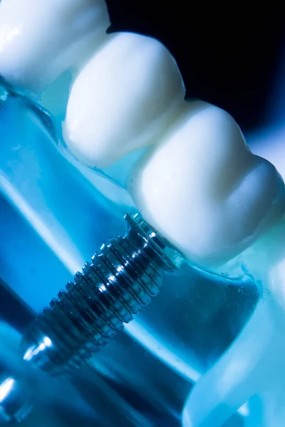 歯と歯茎を示す歯科歯金属インプラント歯科教育モデル ロイヤリティフリーのストック写真