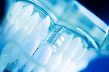 Diş implantı titanyum protez dişçi modeli..