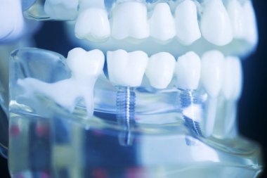 Diş implantı titanyum protez dişçi modeli..