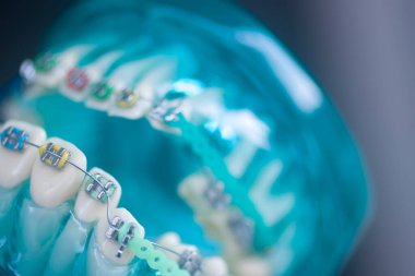 Diş macunu hizalayıcı diş etleri ve metal diş düzleştiricileri gösteren öğrenci modeli öğretiyor..