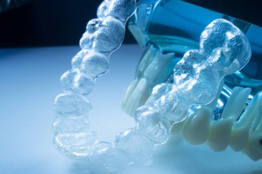 Modern görünmez parantez hizalayıcıları dişçiler tarafından dişlerin hizalanmasını düzeltmek için kullanılır.