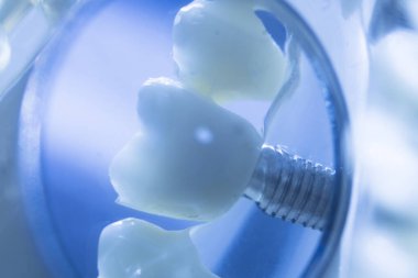 Diş macunu implantı. Diş ve sakız gösteren bir model..