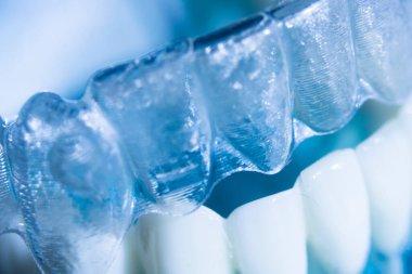 Modern görünmez parantez hizalayıcıları dişçiler tarafından dişlerin hizalanmasını düzeltmek için kullanılır.