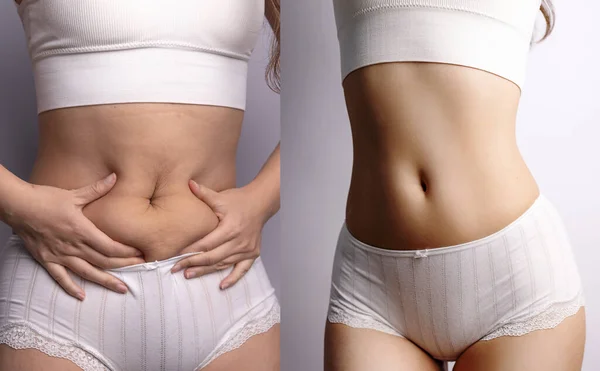 Before after excessive belly fat. Healthcare and woman diet lifestyle concept to reduce belly and shape up healthy stomach muscle. Cellulite.