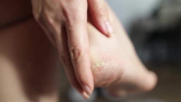 Index Finger Shows Cracked Heel Rough Skin Foot Pedicure Ourselves — Stock videók