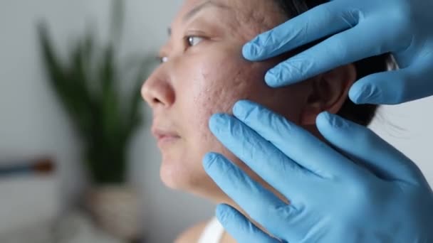 Dermatolog Bada Skórę Młodej Kobiety Trądzikiem Blizny Rany Twarzy — Wideo stockowe
