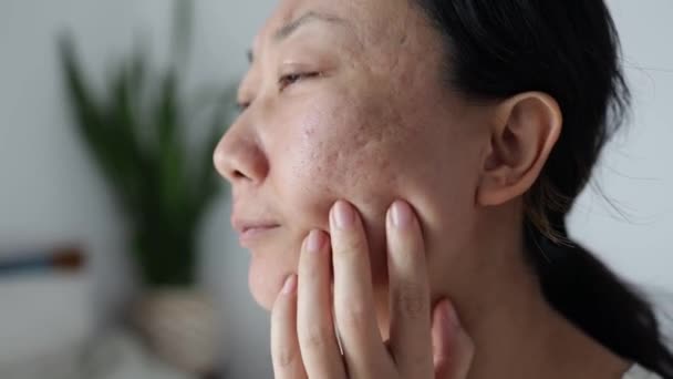 Close Sad Asian Woman Touching Acne Her Face — Stock videók