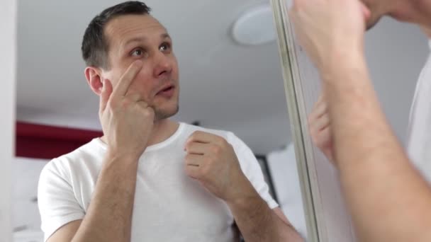 Close Cabeça Tiro Espelho Reflexão Jovem Irritado Com Seco Olhar — Vídeo de Stock