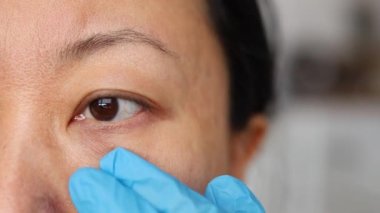 Blepharoplasty, bir cerrah daha fazla ameliyat için göz kapaklarında işaretler yapar.