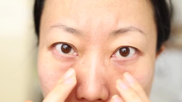 Mujer Asiática Con Bajo Ojo Bolsa Ojo Hinchado Chica Mostrando — Vídeos de Stock