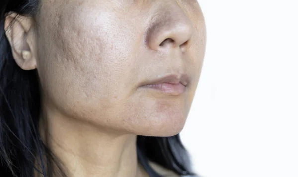 Akne Narben Auf Der Wange Gesicht Von Frauen Der Grund — Stockfoto