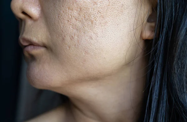 Acne Scars Cheek Face Women Reason Overlay Skin Breaks Leaves — Stock Photo, Image