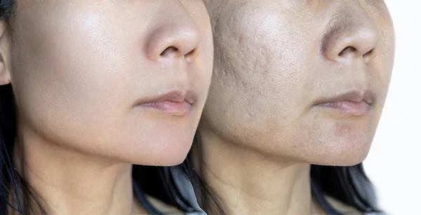 Kožní Problémy Jizva Akné Před Akné Ošetření Obličeje Krása Koncept — Stock fotografie