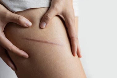 Derisinde termal yanık olan bir kadın bacağı. Ütü yaparken ya da yemek pişirirken aile içi yaralanma. Bacaklardaki yaralar kadının..