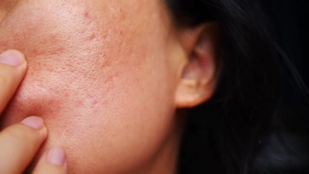 Acne Scars Cheek Face Women Reason Overlay Skin Breaks Leaves — Stock Video
