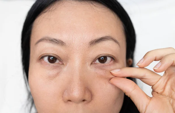 Wanita Asia Dengan Tas Bawah Mata Puffy Eye Girl Showing — Stok Foto