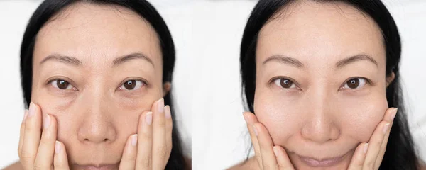Kozmetik Ameliyatlardan Önce Asyalı Bir Kadının Mutlu Yüzü Cilt Bakımı — Stok fotoğraf
