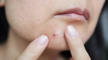 Suratındaki sivilcelere dokunan üzgün kadını kapat..