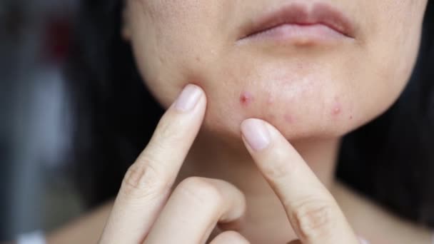 Close Sad Woman Touching Acne Her Face — Stock Video