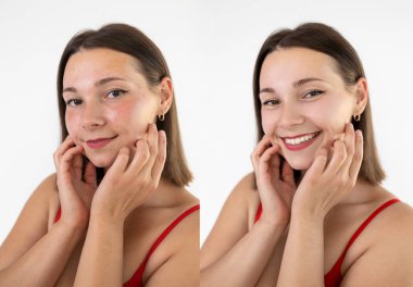 Rosacea 'nın öncesi ve sonrası lazer tedavisi, sivilceler. Başarılı bir müdahale. Sivilce tedavisi prosedürü. Deri bakımı konsepti. Beyaz arka planda tedavi öncesi ve sonrası akne sorunu olan genç bir kadın..