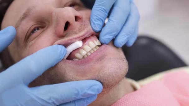 Dentista Uomo Accoglienza Dall Ortodontista Lucidatura Incollaggio Gel — Video Stock
