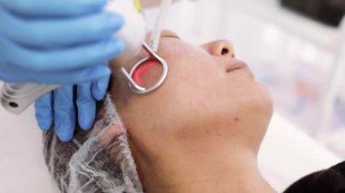 Kesirli lazer karbondioksit prosedürü. Güzellik kliniğinde kozmetik tedavi. Cilt bakımında lazer tedavisi gören bir kadın. Yüzündeki kırışıklıklar, yaralar ve güneş hasarları için yüzeye çıkma tekniği.. 