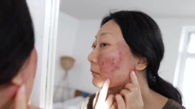 Yüzünün pürüzsüz görünmesi için karbondioksit lazeri ile yüz bakımı yaptıran Asyalı bir kadının yüzü. Lazer bu sorunu çözebilir.