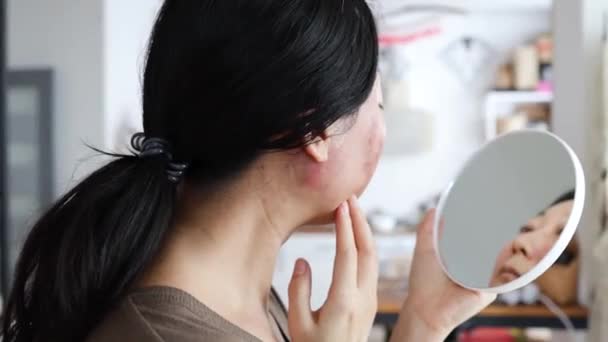 顔を滑らかに得るために彼女のアクネの傷を扱うためにCo2レーザーによって顔の皮の処置を受けたアジアの女性の顔 レーザーはこの問題を解決できます — ストック動画