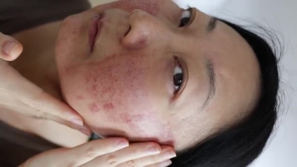 Tvář Asijské Ženy Která Byla Ošetřena Obličejovou Kůží Laserem Co2 — Stock video