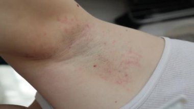Koltuk altı alerjisi. Genç adam jilet, budama, zehirli deodorant ya da terleme önleyici kullandıktan sonra hassas ciltte elle tahriş gösteriyor ve kaşınıyor. Deri döküntüsü veya atopik deri iltihabı. Sivilce ya da kırmızı noktalar