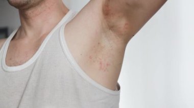 Koltuk altı alerjisi. Genç adam jilet, budama, zehirli deodorant ya da terleme önleyici kullandıktan sonra hassas ciltte elle tahriş gösteriyor ve kaşınıyor. Deri döküntüsü veya atopik deri iltihabı. Sivilce ya da kırmızı noktalar