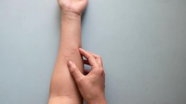 Alerjik reaksiyon yüzünden kaşınan ve kollarını kaşıyan Asyalı bir kadın. Cildinde egzama iltihabı var. 