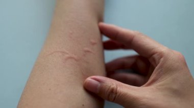 Alerjik reaksiyon yüzünden kaşınan ve kollarını kaşıyan Asyalı bir kadın. Cildinde egzama iltihabı var. 