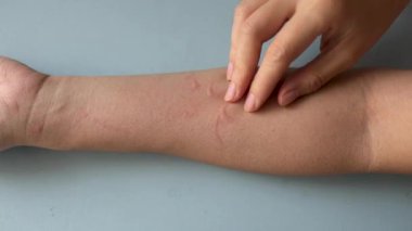 Alerjik reaksiyon yüzünden kaşınan ve kollarını kaşıyan Asyalı bir kadın. Cildinde egzama iltihabı var. 