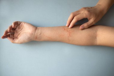 Alerjik reaksiyon yüzünden kaşınan ve kollarını kaşıyan Asyalı bir kadın. Cildinde egzama iltihabı var. 