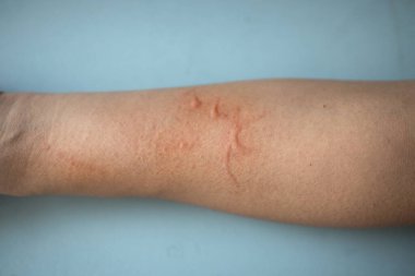 Alerjik reaksiyon yüzünden kaşınan ve kollarını kaşıyan Asyalı bir kadın. Cildinde egzama iltihabı var. 